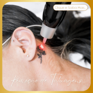 Remoção de Tatuagens​