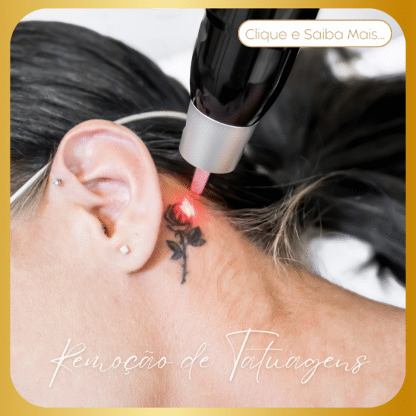 Remoção de Tatuagens​